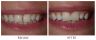 Diastema Closure with Composite Bonding