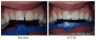 Diastema Closure with Composite Bonding