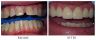 Porcelain Crowns and Veneers